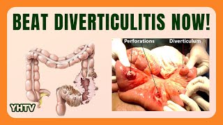 Diverticulitis Diet Best Foods Tips amp Meal Plans to Heal Diverticulitis [upl. by Arait112]