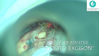 Valecullar cyst  Transoral laser surgery assisted excision [upl. by Annauqahs]