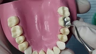 ازاى تعمل quotAmalgam restoration class I compound for upper 6 with matrix band [upl. by Queridas846]