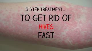 INCREDIBLE 3 Step Treatment To Get Rid Of Your Hives FAST [upl. by Moynahan31]