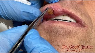 Removal of a pyogenic granuloma on the lip [upl. by Ettenor]