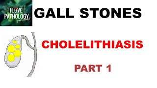 CHOLELITHIASIS GALL STONESPart 1 Epidemiology Types Risk factors [upl. by Umberto]