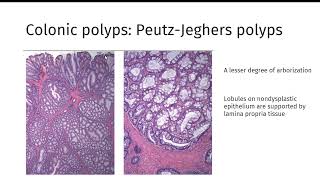 GI polyps GIPATH [upl. by Akirdnwahs]