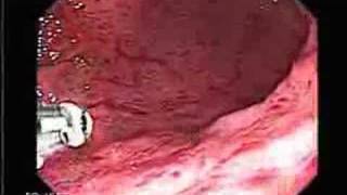 Video Endoscopy of Severe gastritis [upl. by Yecies]