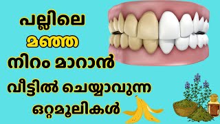 പല്ലിലെ മഞ്ഞ നിറം മാറാൻ  പല്ല് വെളുക്കാൻ [upl. by Enelyw]