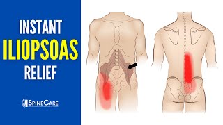 How to Instantly Relieve Iliopsoas Muscle Tightness AND PAIN [upl. by Edora]