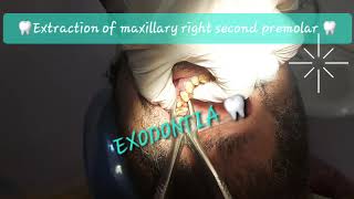 Buccal to lingual motion maxillary 2nd premolar extraction with double curvatures Sshaped roots [upl. by Nileuqaj]