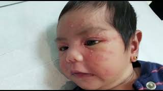 visual initial newborn assessment neonatal Acne cephalic pustulosis erythema toxicum pustular DD [upl. by Amees]