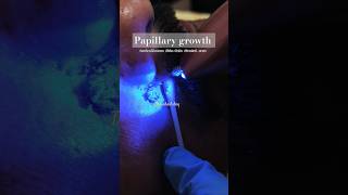 Mole removal laser treatment lasertreatment drrichadubey painlesslaser shortsfeed trending [upl. by Vinaya803]