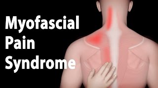 Myofascial Pain Syndrome and Trigger Points Treatments Animation [upl. by Aihsakal51]