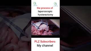 the process of laparoscopic hysterectomy laparoscopicsurgery hysterectomy foryou bomb fypシ [upl. by Avika]