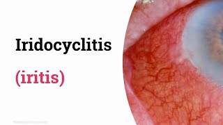 Iridocyclitis iritis [upl. by Cly673]