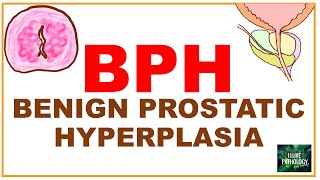 Benign Prostatic Hyperplasia  BPH etiopathogenssis Pathology amp clinical features [upl. by Ahseek516]