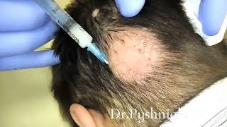 Intralesional corticosteroid injections for alopecia areata [upl. by Aihsetan807]