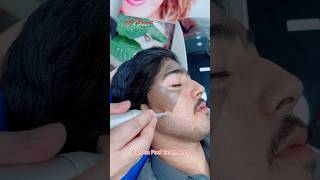 Carbon Peel Laser getsmarthairclub viralvideo beauty [upl. by Airb38]