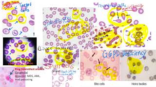 hematology in 10 min Peripheral blood smear examination under microscope [upl. by Faxon]