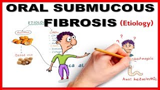 Oral Submucous Fibrosis OSMF Etiology [upl. by Hen]