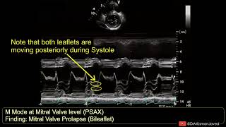 Bileaflet Prolapse of Mitral Valve on M Mode Echocardiography echocardiagram [upl. by Cobby]