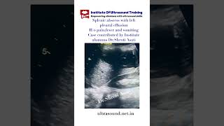 SPLENIC ABSCESS WITH LEFT PLEURAL EFFUSION drrandhawainstitute pocus ultrasound medicalvideos [upl. by Ademla]