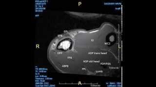 MRI partial rupture radial collateral ligament MCP 1 joint [upl. by Aphra]