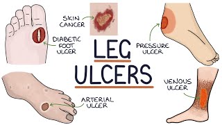 Understanding Leg and Foot Ulcers [upl. by Yonatan]