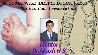 CONGENITAL TALIPES EQUINOVARUS Clinical Case Presentation [upl. by Madid204]