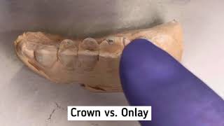 Onlay vs Crown What’s the difference John Vargas DDS [upl. by Glenda]