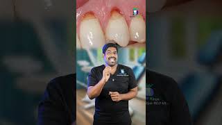 பல் சுத்தம் செய்தால் கூசுமா Sensitivity during dental scaling  DrKarthikeyan  Denta Kings [upl. by Atekal537]