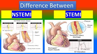 Contrast between NSTEMI and STEMI [upl. by Sandi]