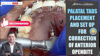 Palatal TADs Placement  Correction of Anterior Openbite  Miniscrews  MiniImplant  SAS  TAD [upl. by Philip]