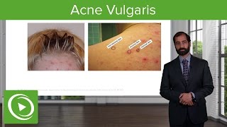 Inflammatory Skin Diseases Acne Vulgaris – Pathology  Lecturio [upl. by Rosenquist124]