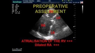 EBSTEIN ANOMALY ANESTHESIA FOR NONCARDIAC SURGERY IN ADULT PATIENT WITH EBSTEIN ANOMALY [upl. by Fran]