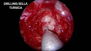 Endoscopic Transsphenoidal Hypophysectomy for Pituitary MacroadenomaDr Babu ARJSS AHER Mysore [upl. by Oidiple]