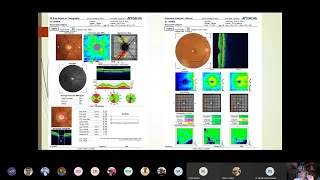 Interpretation of OCT Optic Nerve [upl. by Caravette]