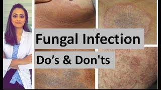 Fungal infection of skin  Dos and Donts  Dermatologist  Dr Aanchal Panth [upl. by Sehguh]