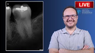 Rtx of 🦷37 with Acute Irreversible Pulpitis and huge caries ▶️ Part 1  CASE174 [upl. by Oz831]