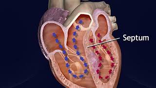 Hypertrophic Obstructive Cardiomyopathy Animation  Treatment Procedure for HOCM Video [upl. by Annai512]