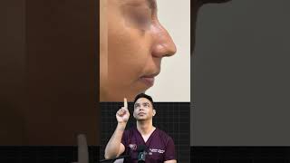 Before and after of Rhinoplasty in one of my patients [upl. by Carolus]