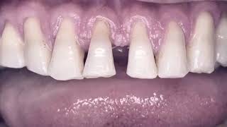 Tips para cierre de diastema [upl. by Bills]