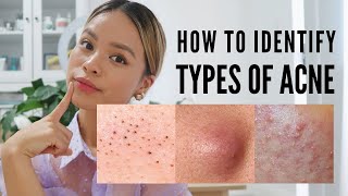 How to treat EVERY type of acne With Pictures [upl. by Barn]