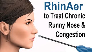 RhinAer to Treat Chronic Runny Nose and Congestion [upl. by Elberfeld239]