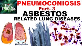 PNEUMOCONIOSIS Part 3 ASBESTOS related lung diseases [upl. by Coulombe]