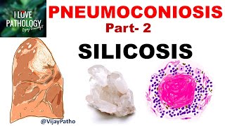 PNEUMOCONIOSIS Part 2 Silicosis pathogenesis morphology  clinical features amp complications [upl. by Eetnahs]