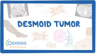 Desmoid Tumor NORD [upl. by Weasner199]