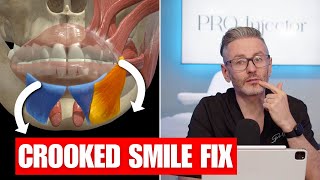 How To Fix An Asymmetrical Smile With Botox [upl. by Davidson99]