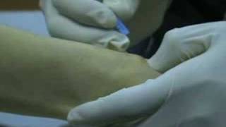 Ganglion Cyst Removal with Acupuncture [upl. by Ritchie686]