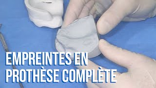 👍 Comment réussir ses empreintes secondaires en prothèse complète [upl. by Marguerie162]