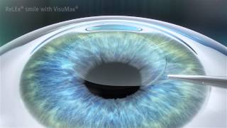 ReLEx SMILE Laser Vision Correction  Minimally Invasive Laser Eye Surgery [upl. by Felder]