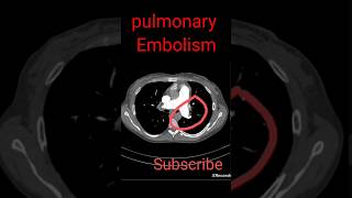 Pulmonary Embolism shorts radiology [upl. by Harmony]