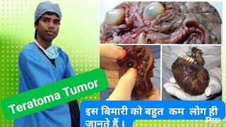 Teratoma in hindi Teratoma kya hota hai Anokha tumor [upl. by Aliet16]